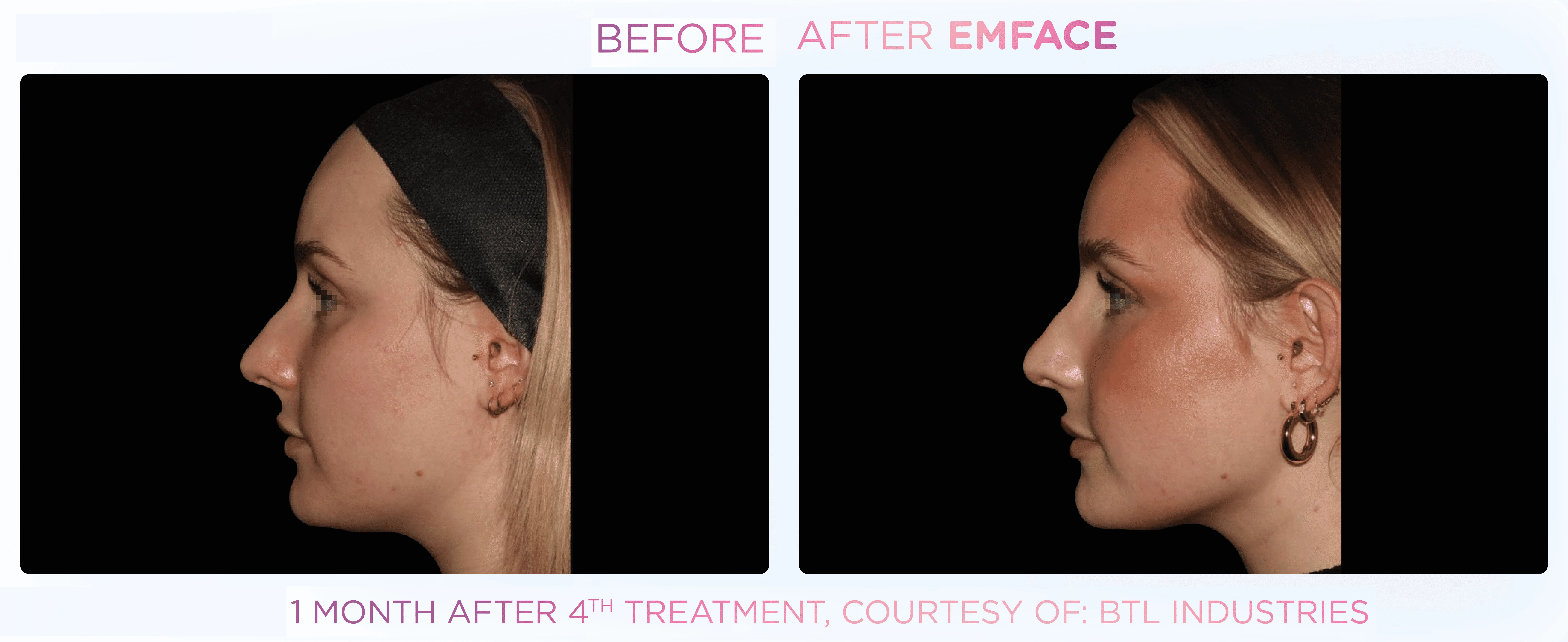 Emface before and after