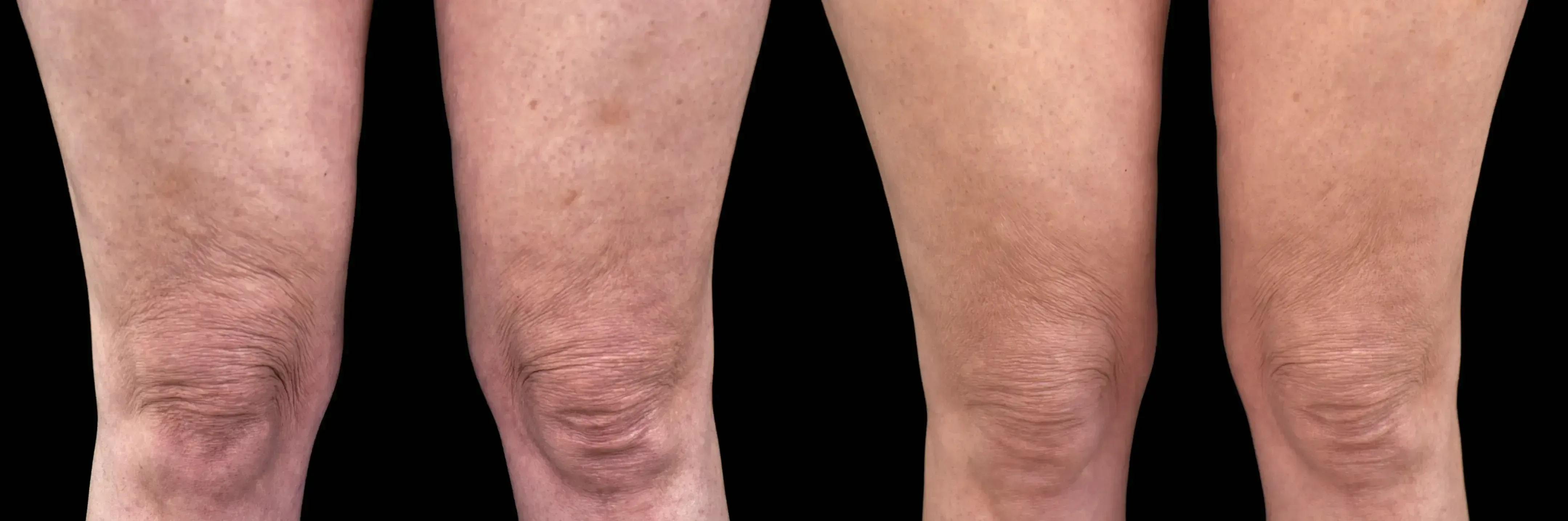 Emtone before and after