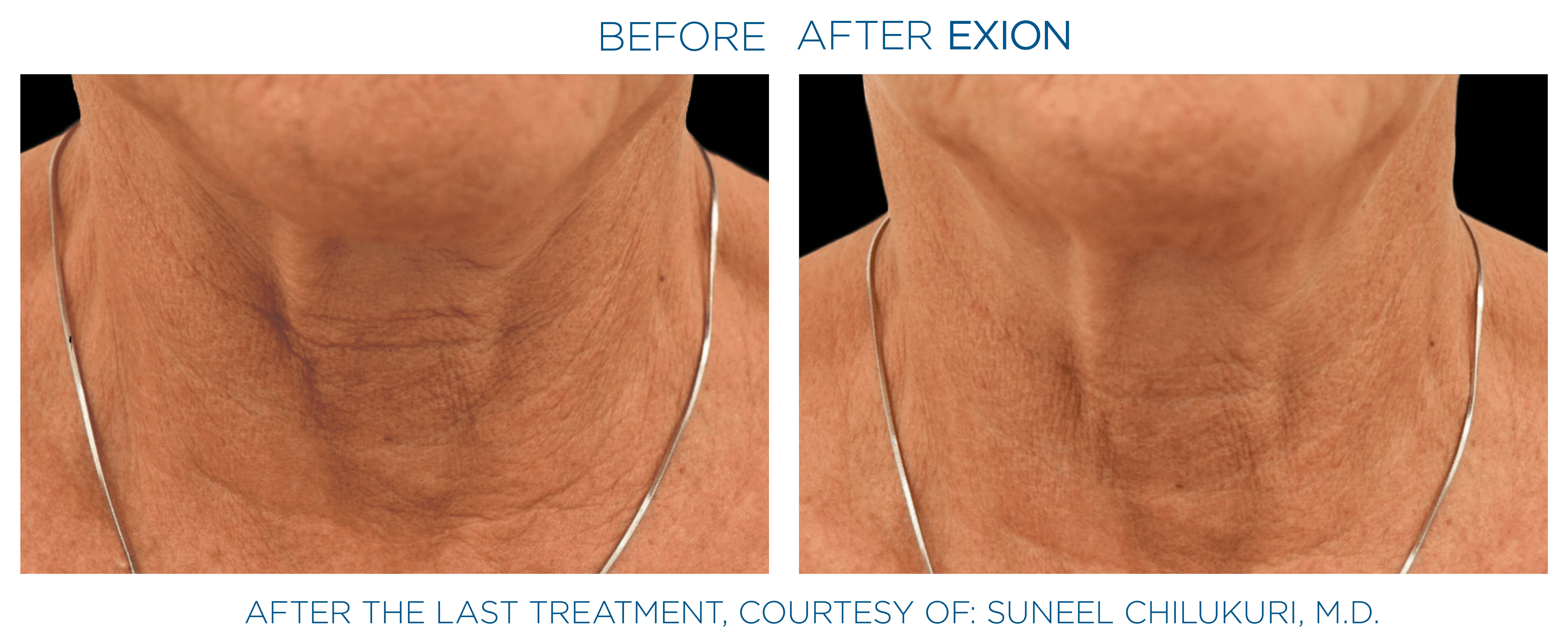 Exion before and after