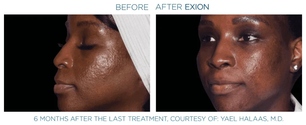 RF Microneedling with Exion before and after