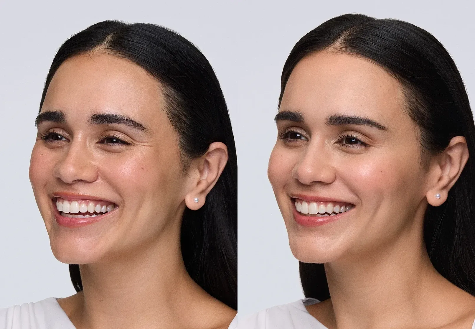 Xeomin before and after