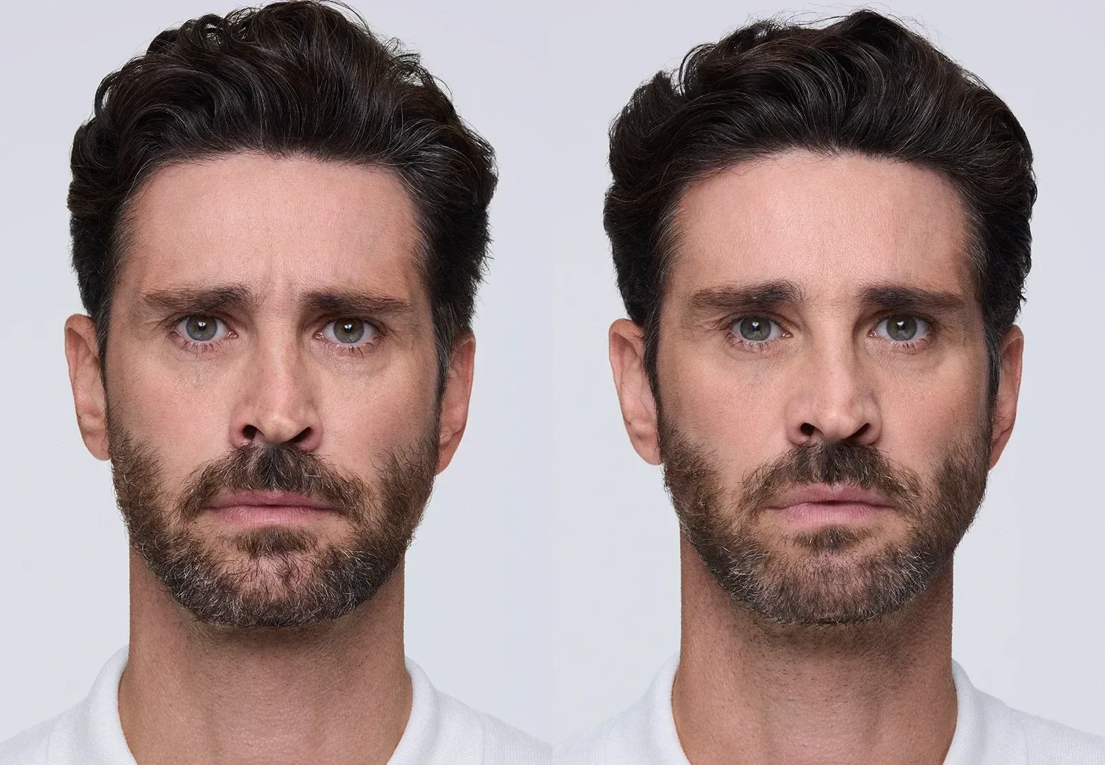 Xeomin before and after