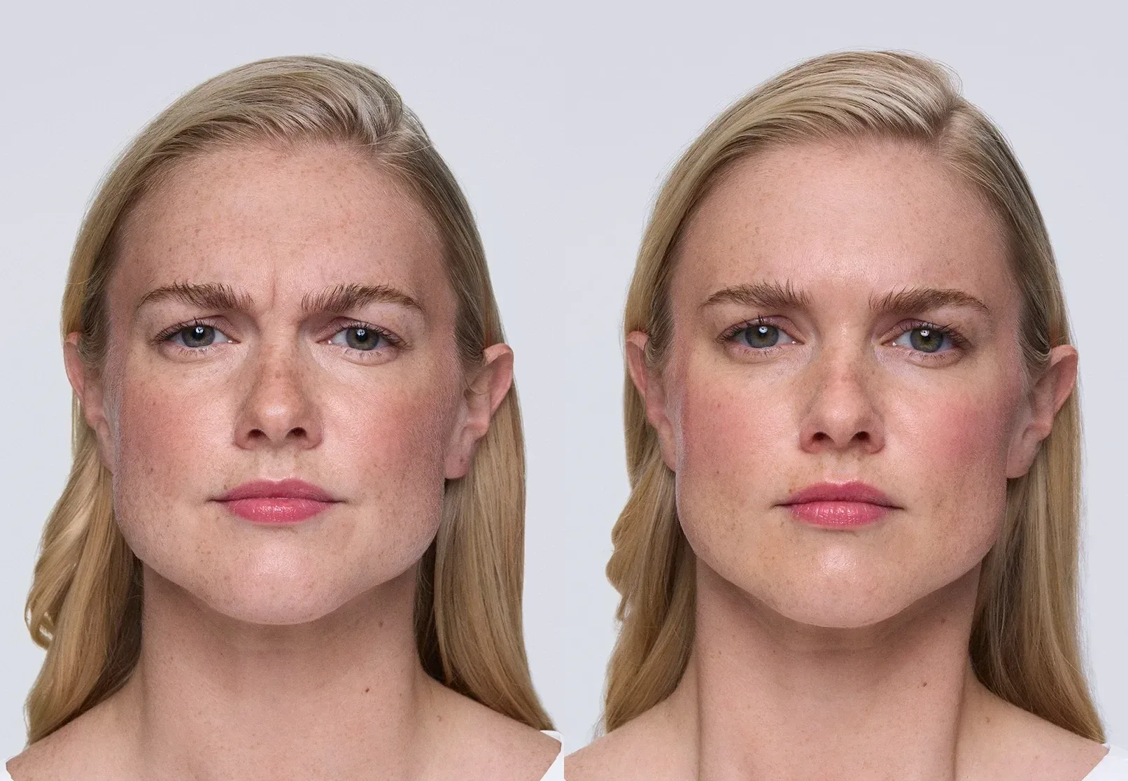 Xeomin before and after