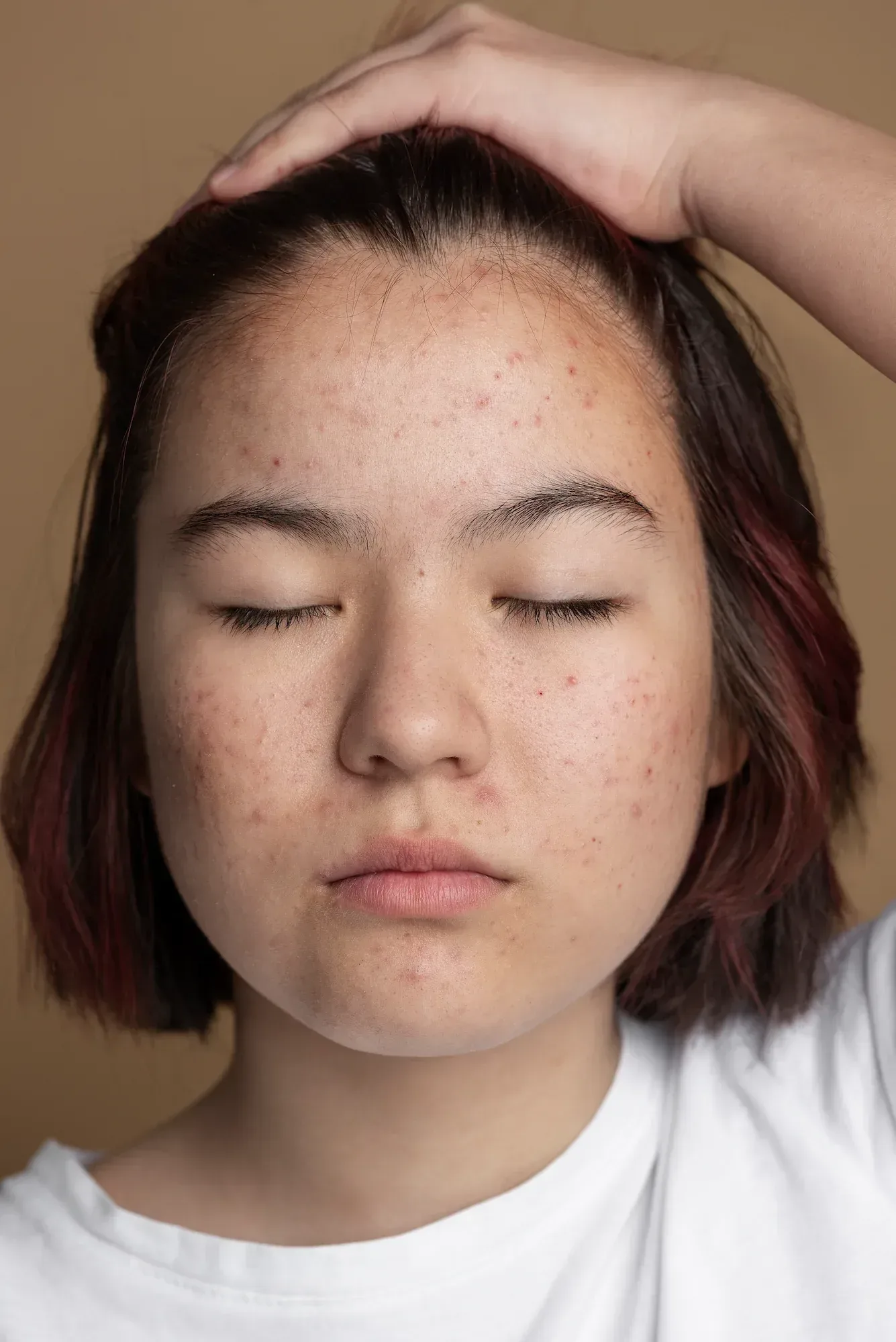 Close-up of inflamed acne papules and clogged pores on adult cheek skin at Desert Oasis Wellness and Med Spa in Lake Havasu City