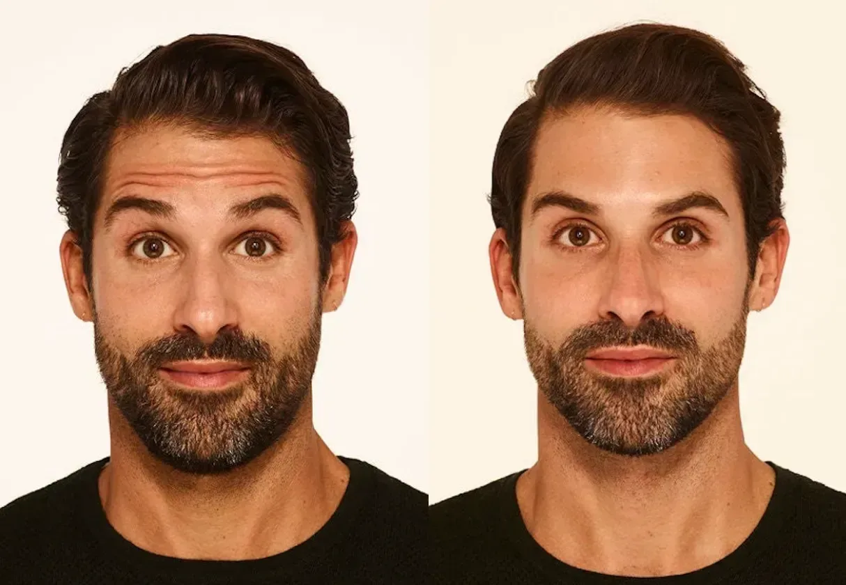 Botox before and after