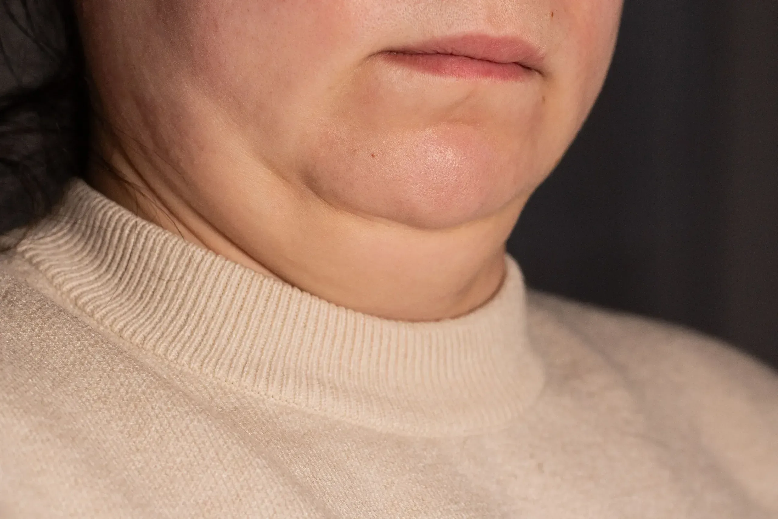 Close-up profile view showing submental fullness beneath the chin and jawline at Desert Oasis Wellness and Med Spa