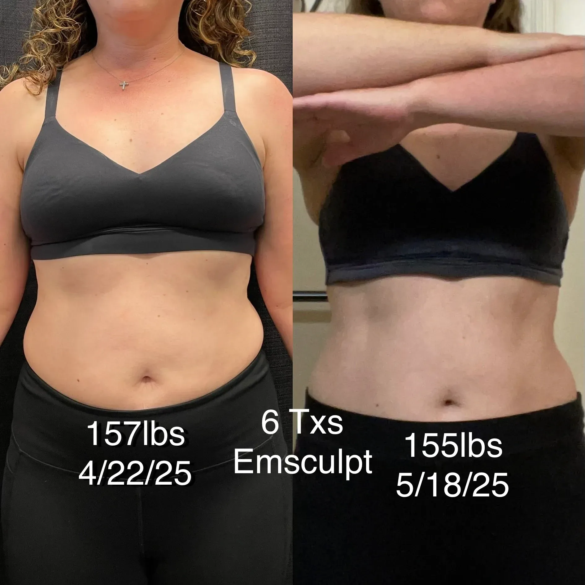 Emsculpt Neo before and after