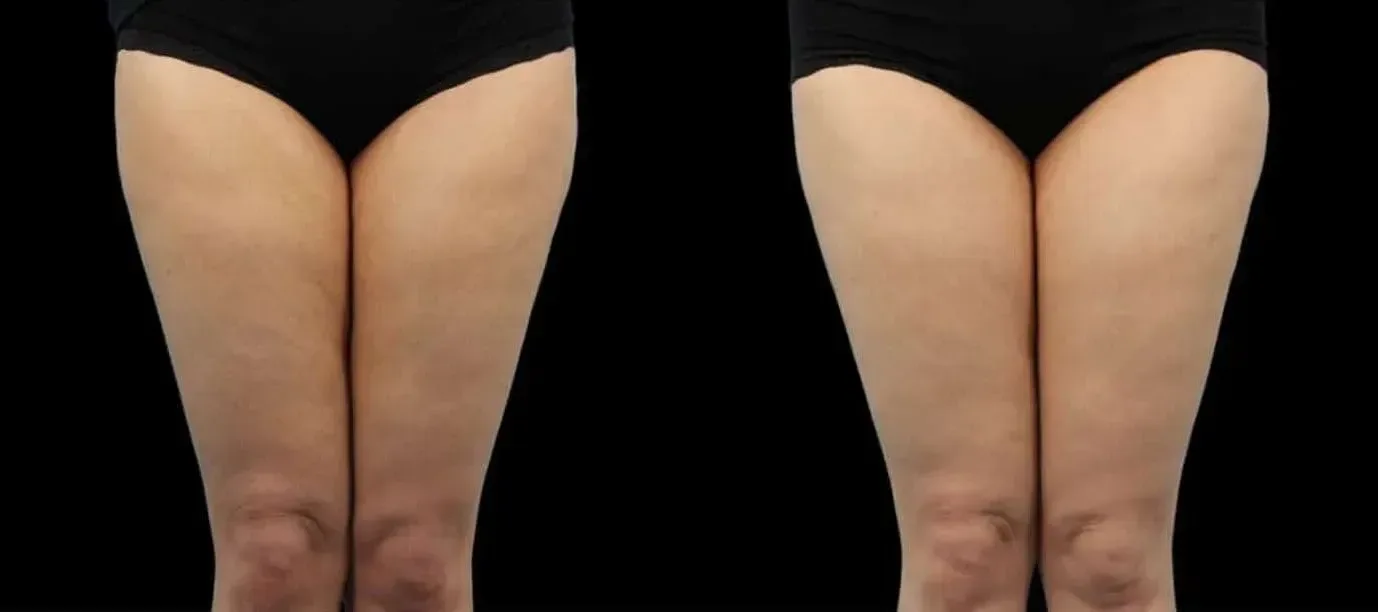 Emtone before and after