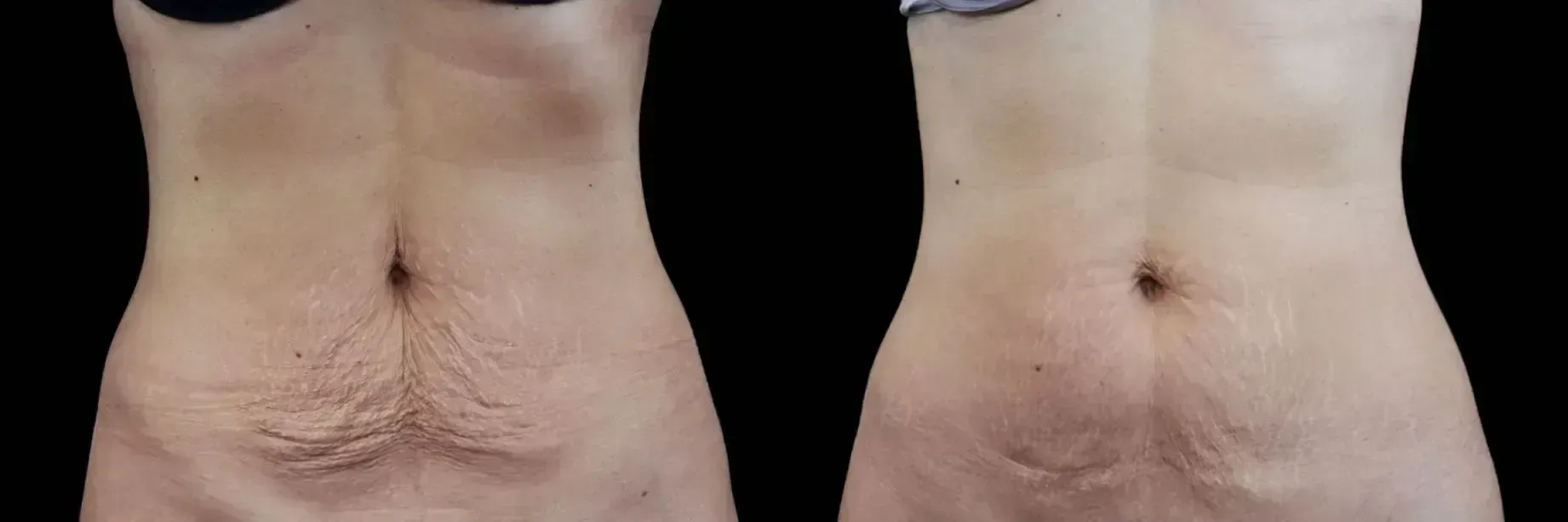 Emtone before and after