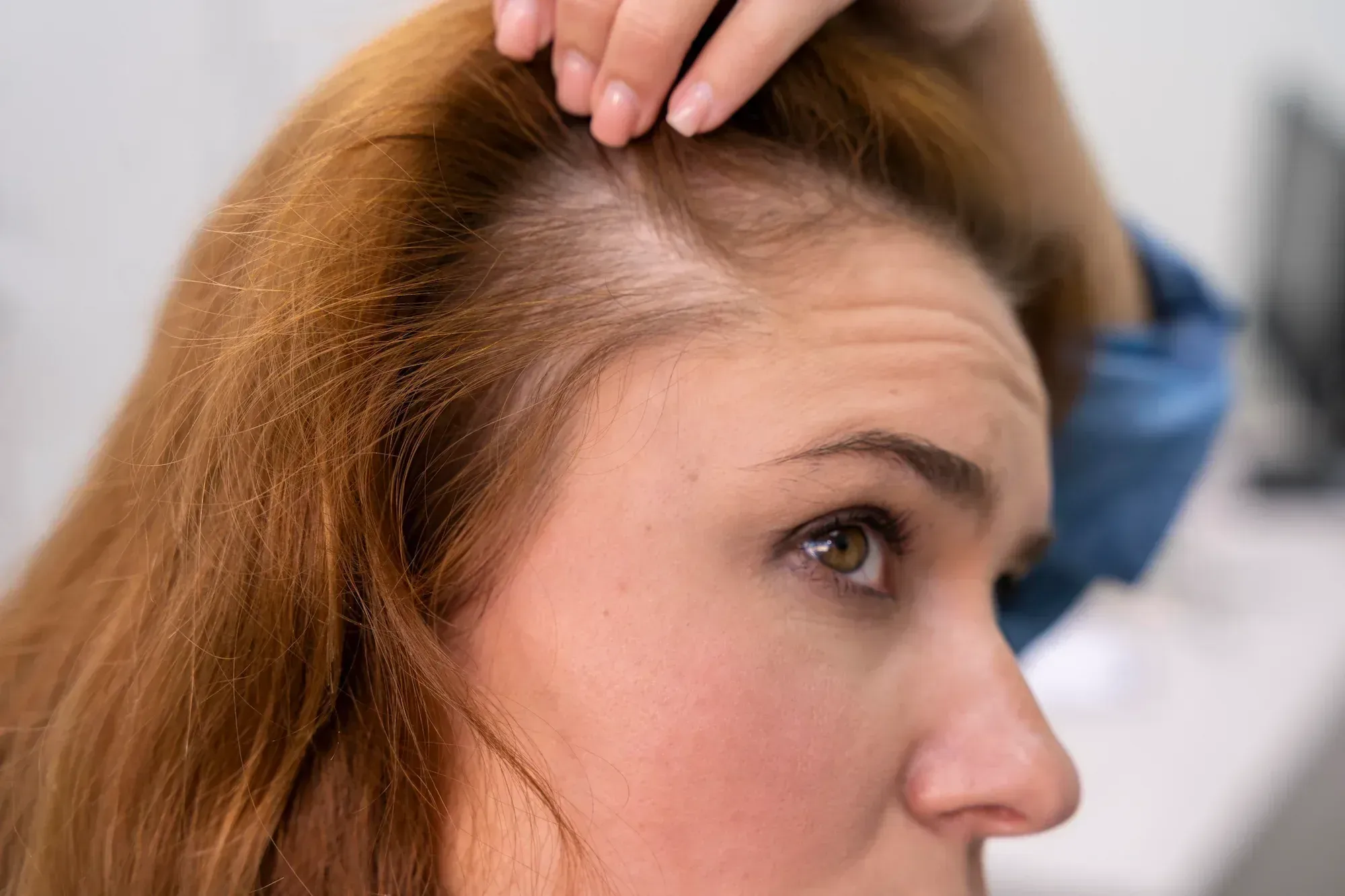 Close-up of diffuse thinning across the top of the scalp on a woman in Lake Havasu City, Arizona