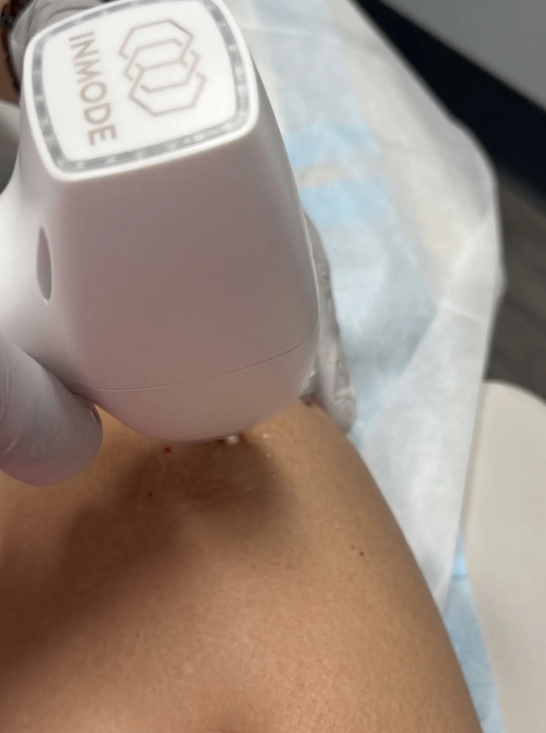 Close comparison of visible leg spider veins before and after Vasculaze laser sessions in Lake Havasu City