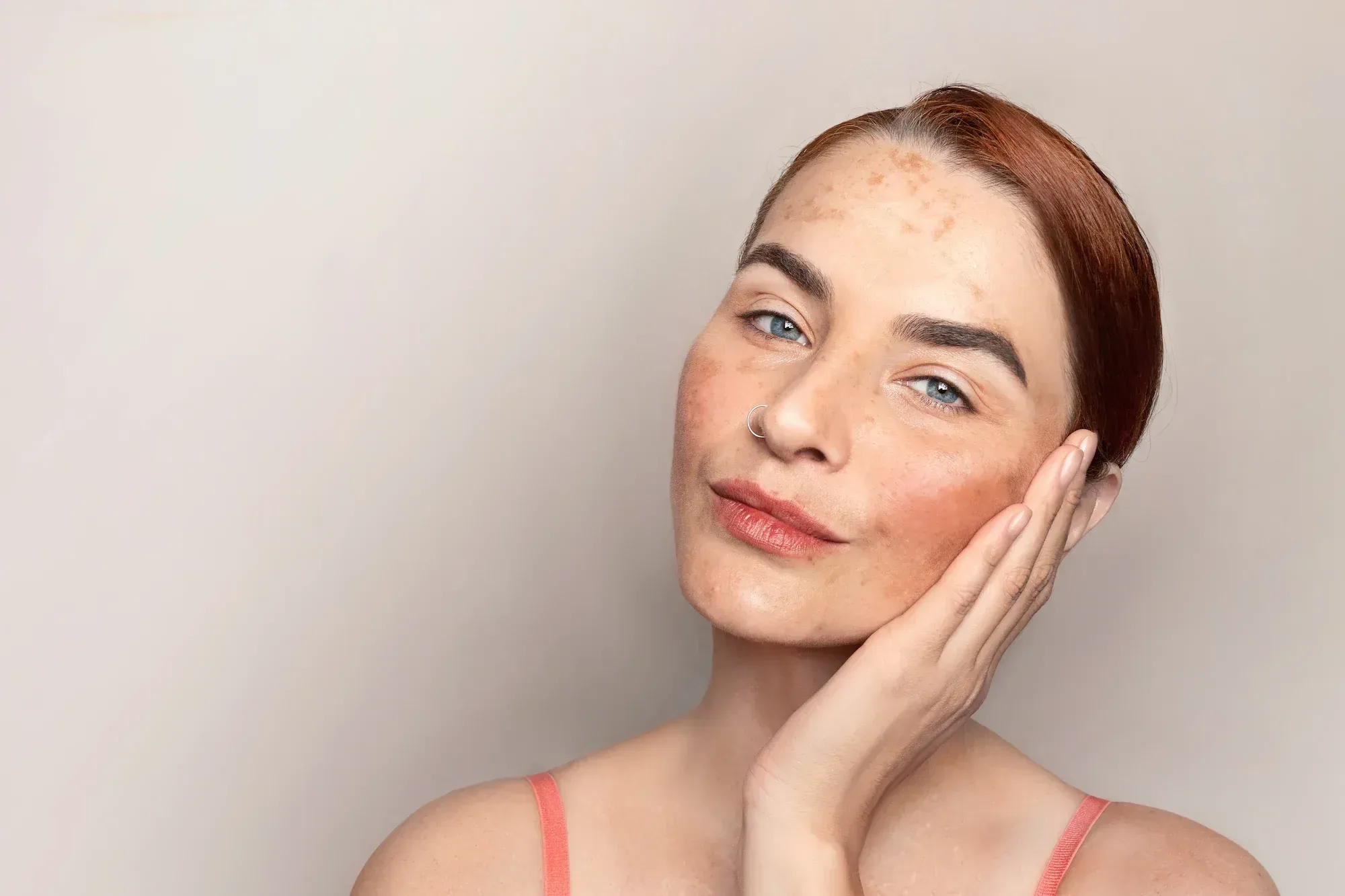 Woman with symmetrical brown melasma patches across her cheeks and upper lip in Lake Havasu City