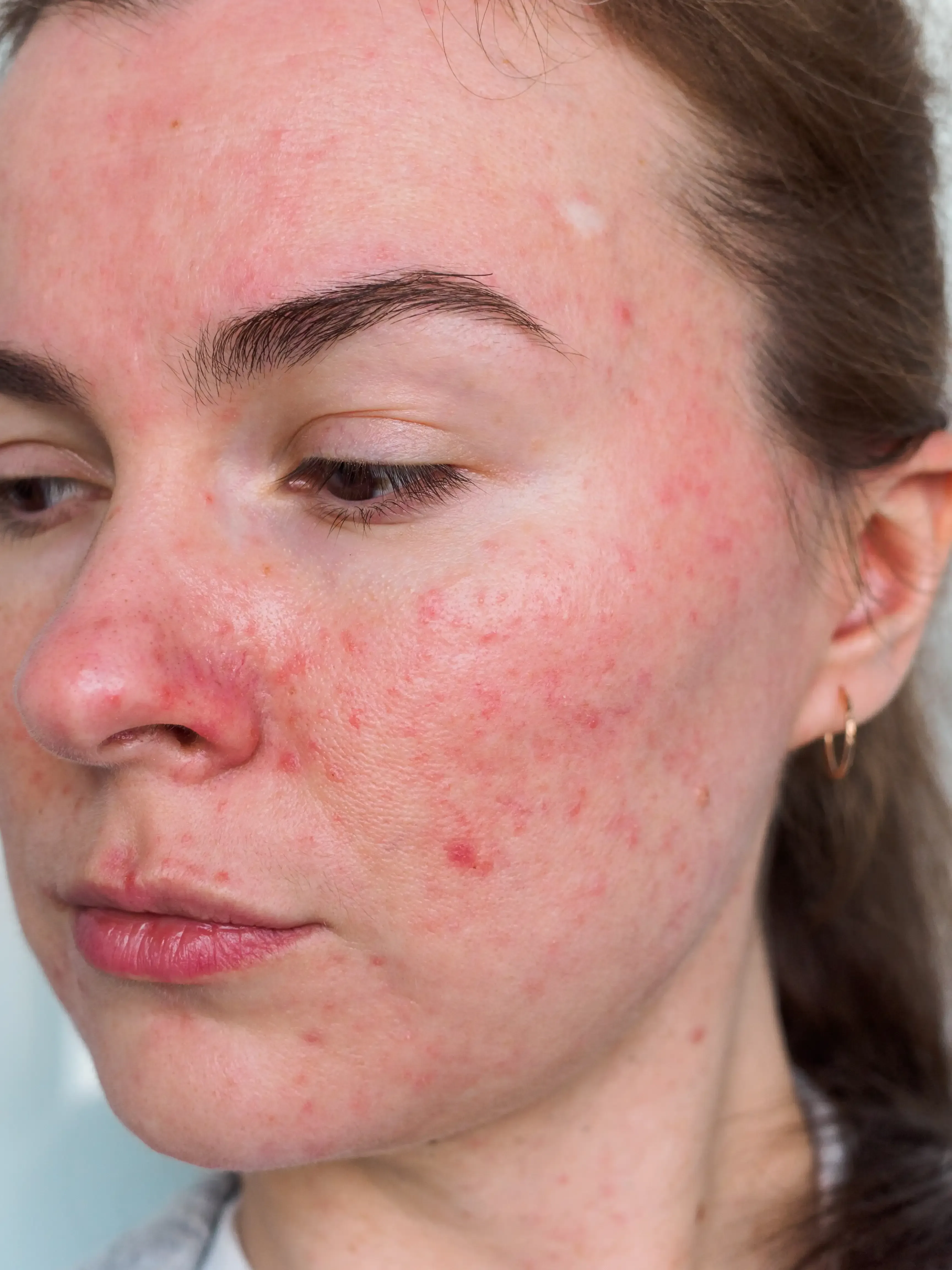 Close-up of persistent facial redness and visible capillaries across the cheeks and nose from rosacea