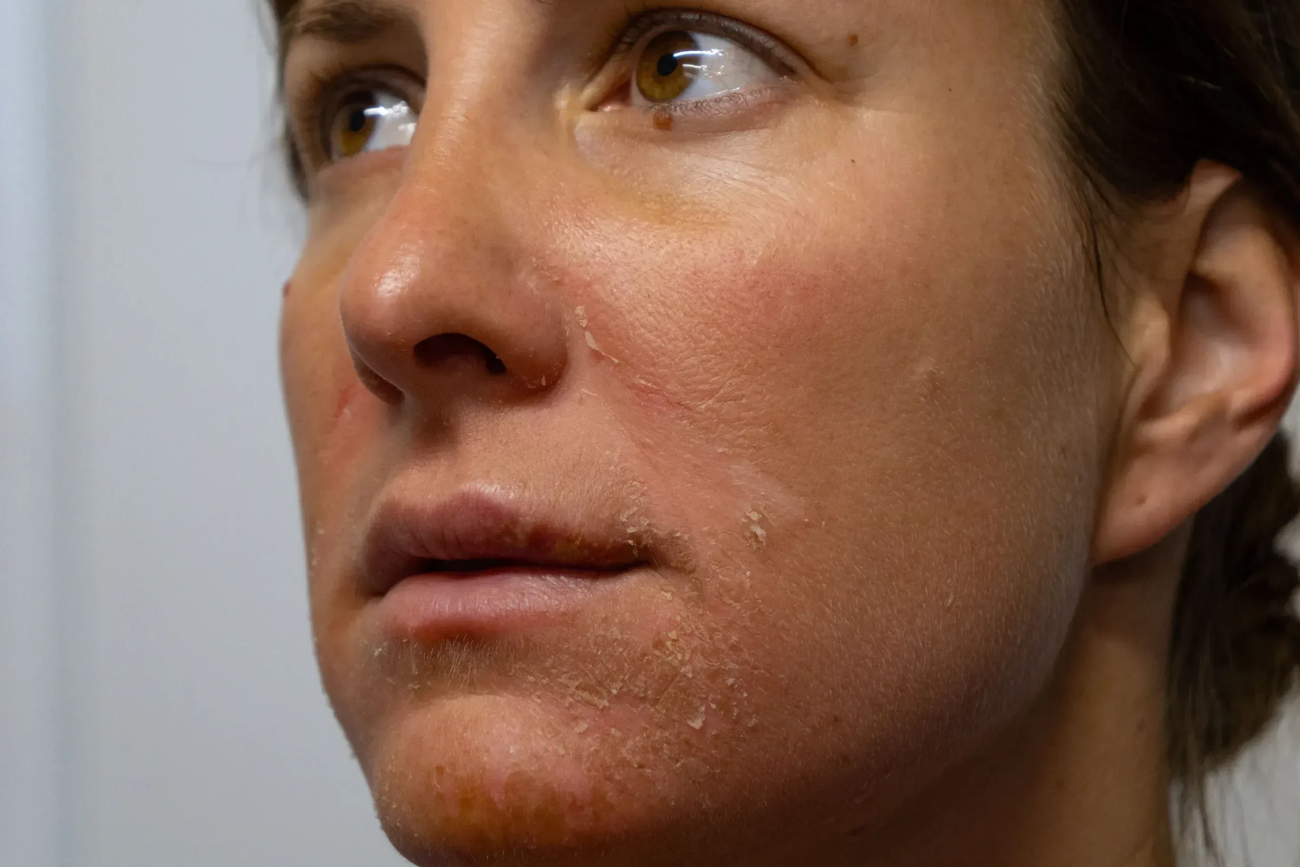Close-up of mottled brown pigment and freckling across sun-exposed cheeks, chest and shoulders