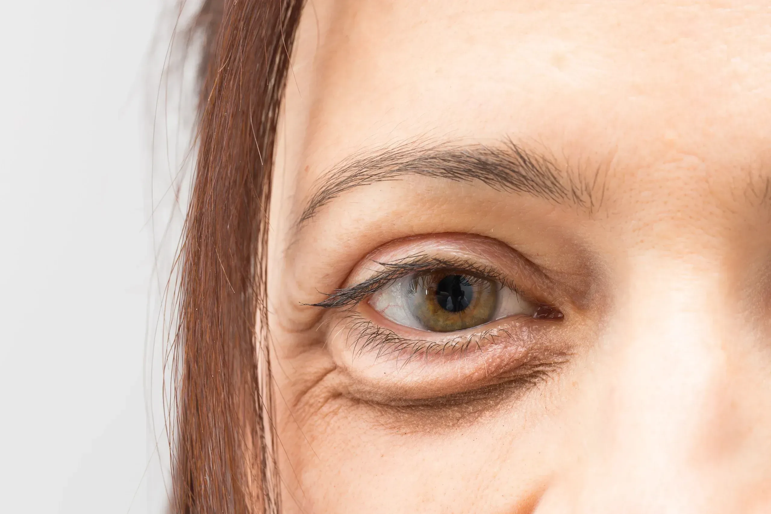Close-up of forehead creases and crow's feet on a mature patient at Desert Oasis Wellness and Med Spa Medspa